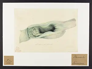 Stomach: Scirrhus of the Stomach
