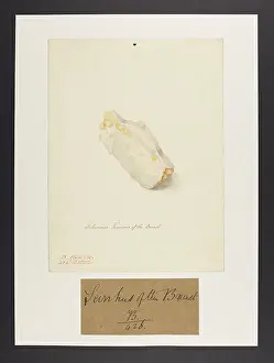 Ucl Library Services Digital Collections: Scirrhus Tumour of the Breast
