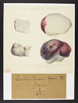 Tumour: Scirrhus Tumour from the Groin