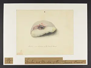 Ucl Library Services Digital Collections: Scirrhus & Ulceration of the Breast