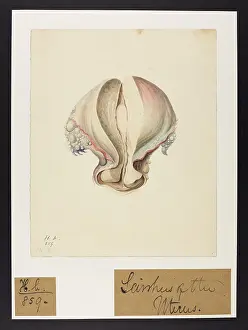 Uterus: Scirrhus of Uterus