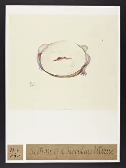 Uterus: Scirrhus Uterus