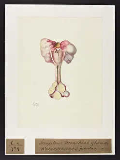 Enlargement: Scrofulous Bronchial Glands
