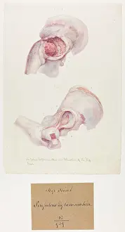 Ulceration: Scrofulous Inflammation and Ulceration of Hip Joint