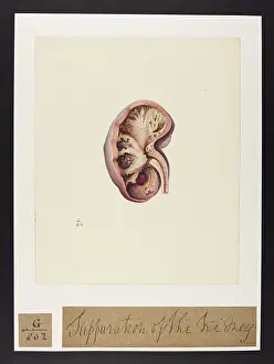 Suppuration: Scrofulous Suppuration of the Kidney