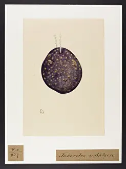 Typhus: Scrofulous Tubercles of the Spleen