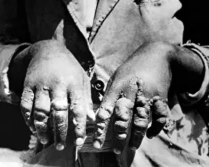 Blistered: Second Italo-Ethiopian War. Evidence of ?