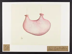 Blank: Sero-gastritis