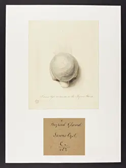 Ucl Library Services Digital Collections: Serous Cyst in the Thyroid Gland