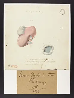 Femmes: Serous Cysts in the Kidney