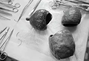 Surgeries: Set of pacemakers