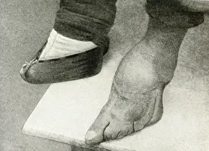 Cripple: Shocking result of binding girls feet, China, East Asia