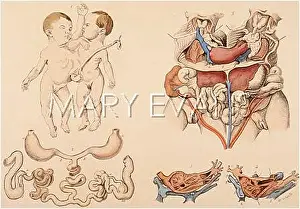 Conjoined: Siamese twins in anatomical drawing
