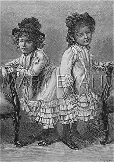 Josepha: Siamese twins from Bohemia