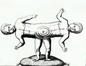 Oddities: SIAMESE TWINS/C18TH