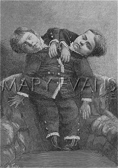 Conjoined: Siamese twins from Italy