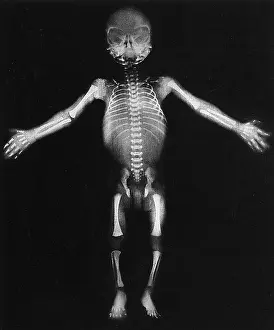 X Ray: Skeleton of a baby