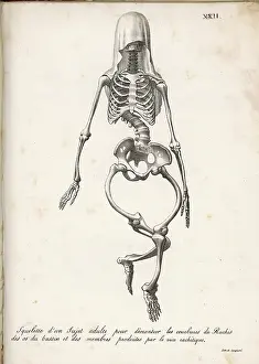 Rickets: Skeleton of Rickets