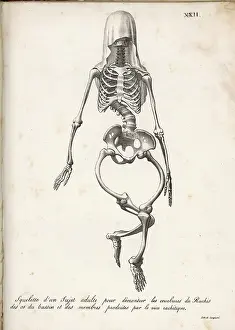 Rickets: Skeleton of Rickets