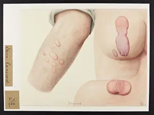 1831: Skin: Canceroid