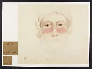 Hopital: Skin: Erythema