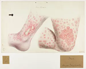 Dieu: Skin: Herpes, Phlyctanodes