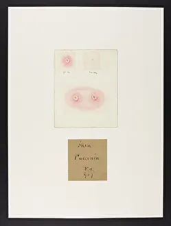 Blank: Skin : Vaccinia