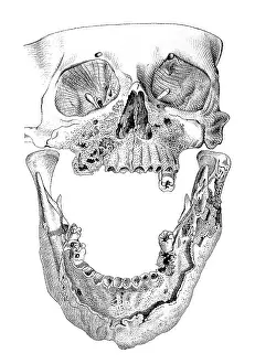 Workings: Skull with Phossy Jaw, Matchmakers Disease