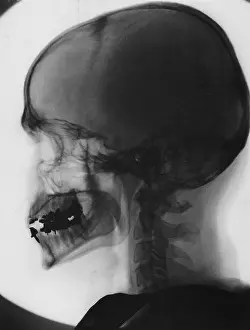 X Ray: Skull x-ray