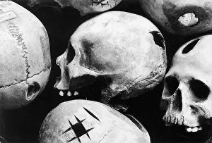 Trepanation: Skulls Showing Trepanation