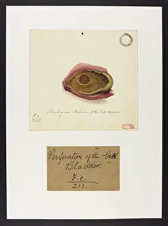 Gall: Sloughing and Perforation of the Gall Bladder