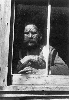 Smallpox: Smallpox
