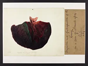 Smallpox: Smallpox: Congestion and Putrfaction of the Lung