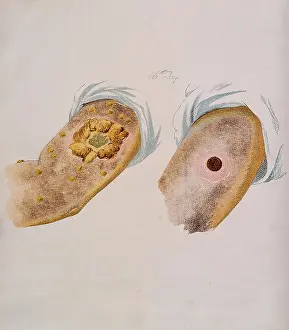 Smallpox: Smallpox and Cowpox Pustules, Day 16, 1896