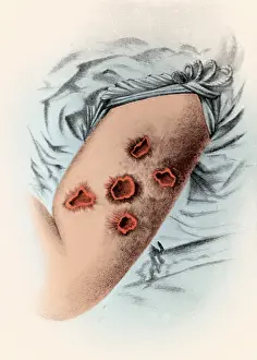 Fatal: Smallpox Pustules, 1898
