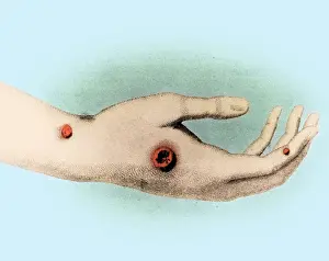 Fatal: Smallpox Sores