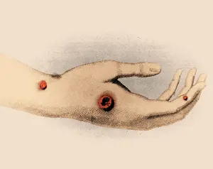 Fatal: Smallpox Sores