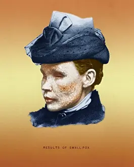 Smallpox: Smallpox Victim
