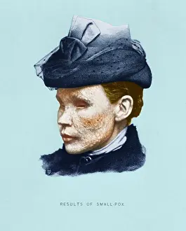Smallpox: Smallpox Victim