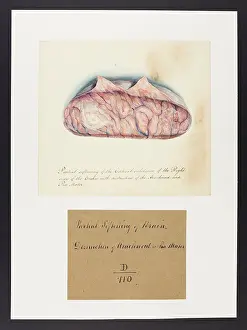 Brain: Softening of the Brain