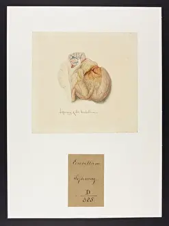 Cerebellum: Softening of the Cerebellum