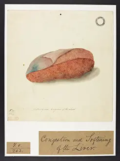 Liver: Softening and Congestion of the Liver