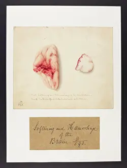 Haemorrhage: Softening and Haemorrhage of Brain