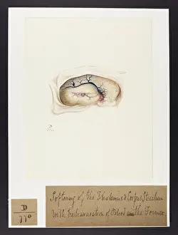 Corpus: Softening of Thalamus and Corpus Striatum