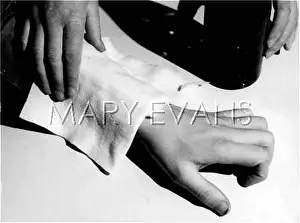 Sprained: SPRAINED WRIST/VINEGAR