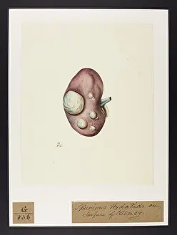 Spurious: Spurious Hydatids on Surface of Kidney