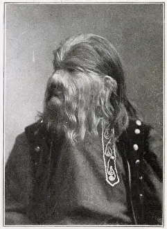 Hypertrichosis: Stephan Bibrowski - Lionel the Lion-faced Man