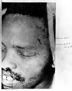Activism: Steve Biko's injuries