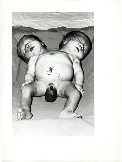 Kilos: Stillborn Siamese twins after Caesarean, operation, Portugal