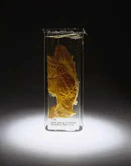 Forensic: Stomach, Hemorrhagic Gastritis, Arsenic Poisoning, 1934